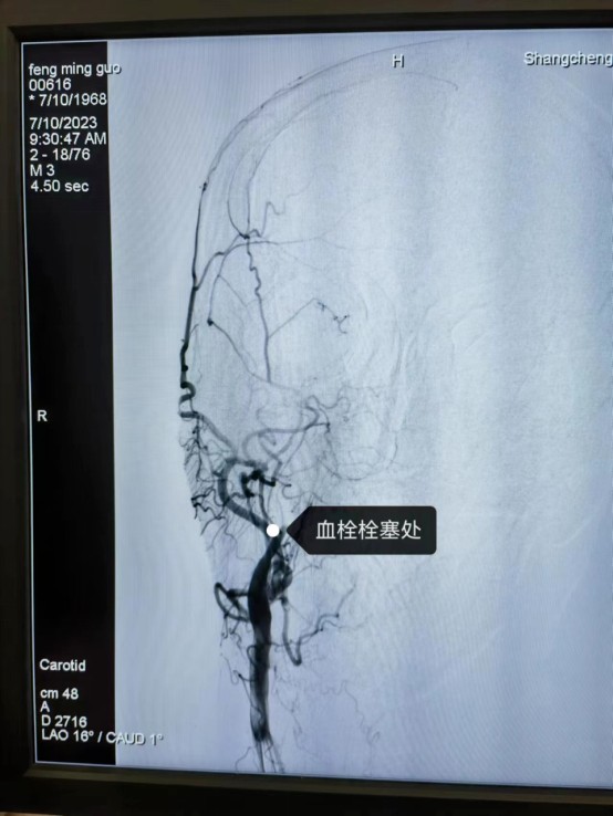 2023-07-21_静脉溶栓桥接取栓，为急性脑梗死患者重开“生命通道”！_8.jpg