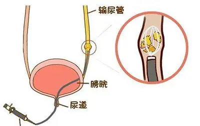 2023-08-03_【专家讲堂】输尿管结石被息肉包裹是因做了体外碎石吗？_3.jpg